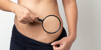 The Science Behind Skin Elasticity & Stretch Marks